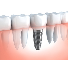 dental implants image