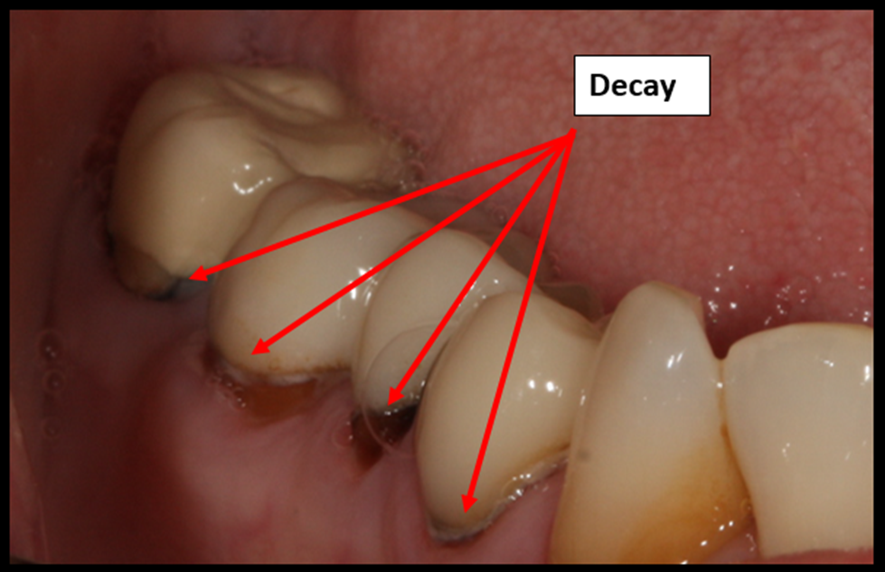 cavity side of molar